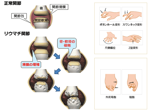 リウマチ関節の状態と症状