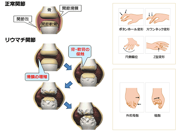 どの抗生物質が関節リウマチを悪化させる可能性がありますか?